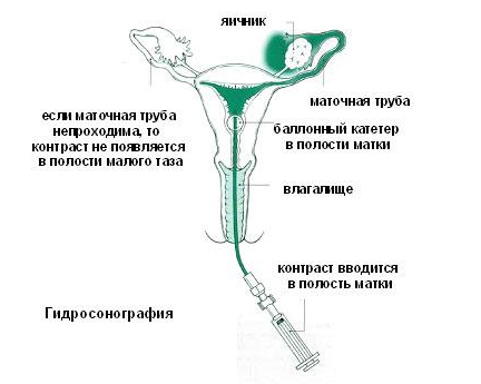 Метод оценки проходимости маточных труб